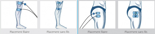 placement electrode TFL syndrome essuie glace